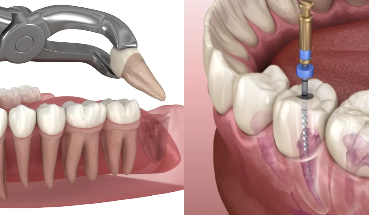 Is Tooth Extraction Better Than Root Canal